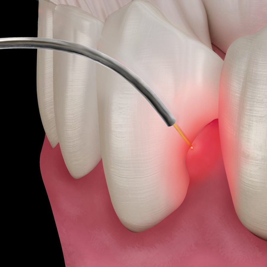 PerioLase fiber treating inflamed gum tissue